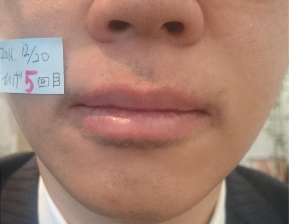 髭脱毛5回目