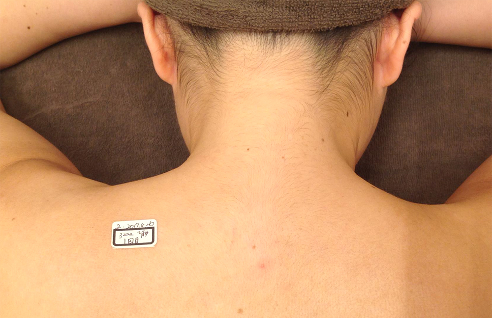 うなじ脱毛Before