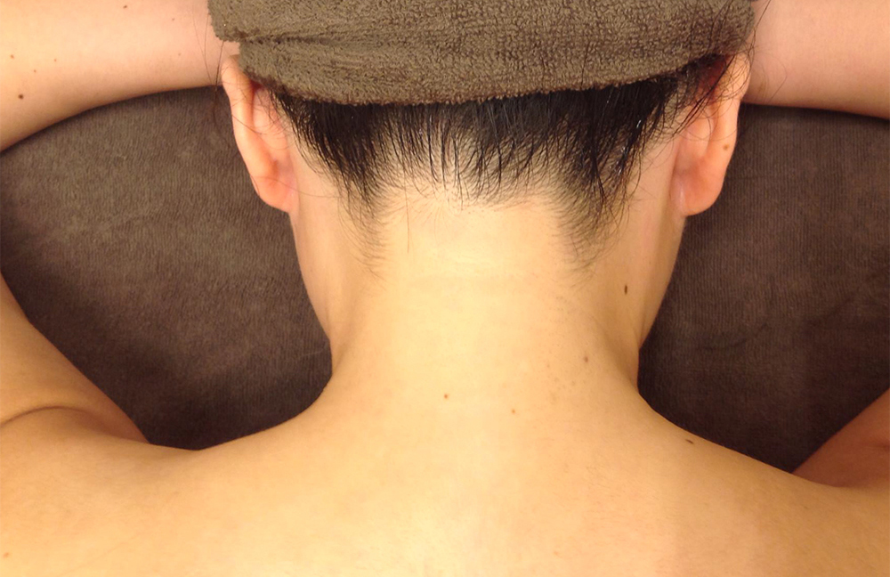 うなじ脱毛After