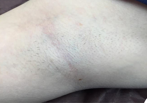 ワキ脱毛施術1回目