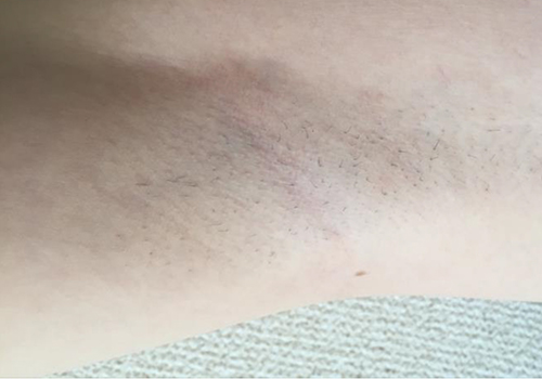 ワキ脱毛施術2回目