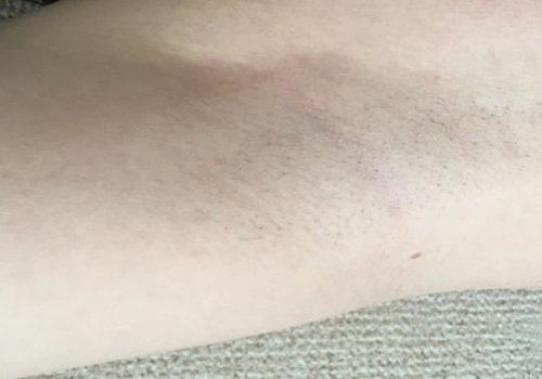 ワキ脱毛施術3回目